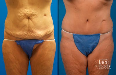 Hidden Tummy Tuck Before & After Gallery - Patient 349113 - Image 1