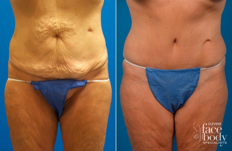 Hidden Tummy Tuck Before & After Gallery - Patient 349113 - Image 1