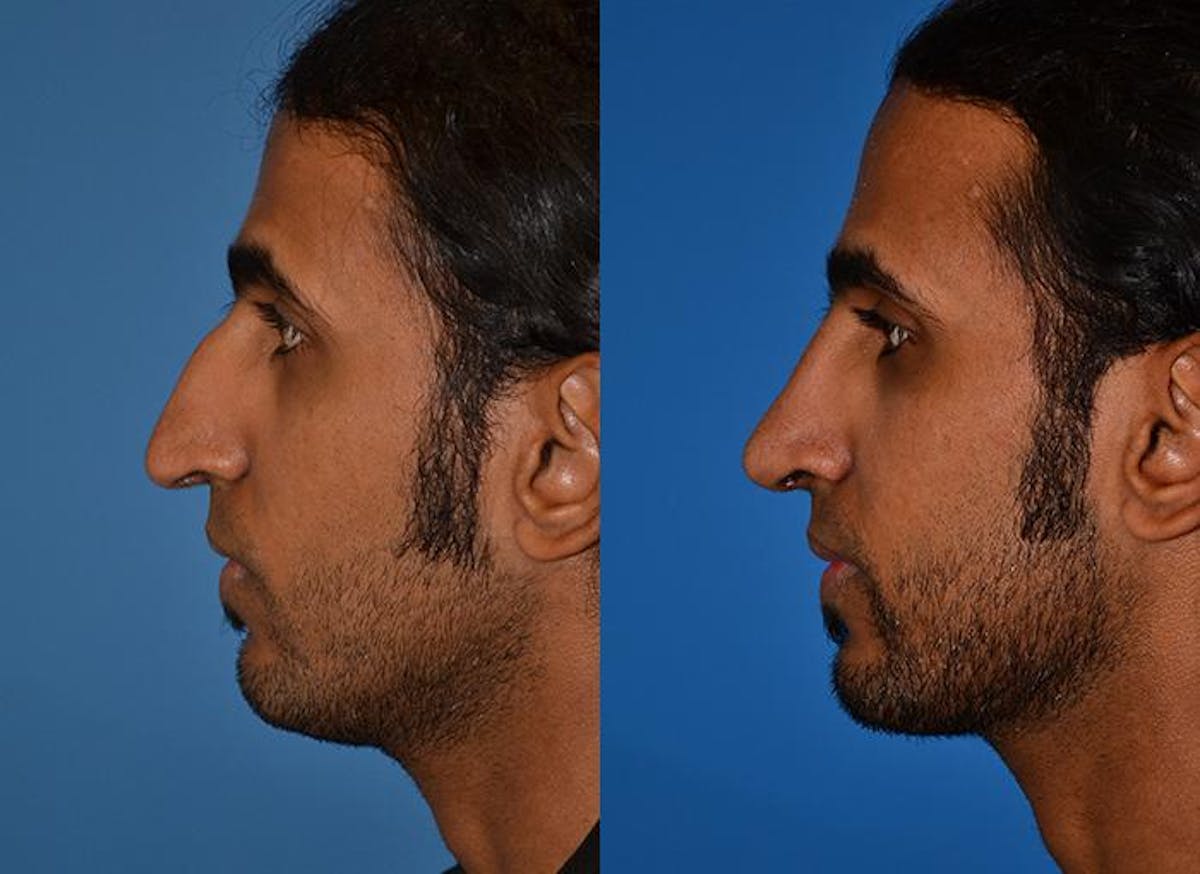 Rhinoplasty Before & After Gallery - Patient 122406748 - Image 3