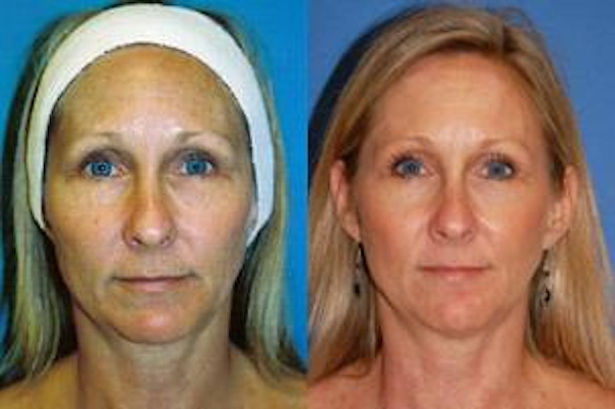 Skin Resurfacing Before & After Gallery - Patient 122406749 - Image 1