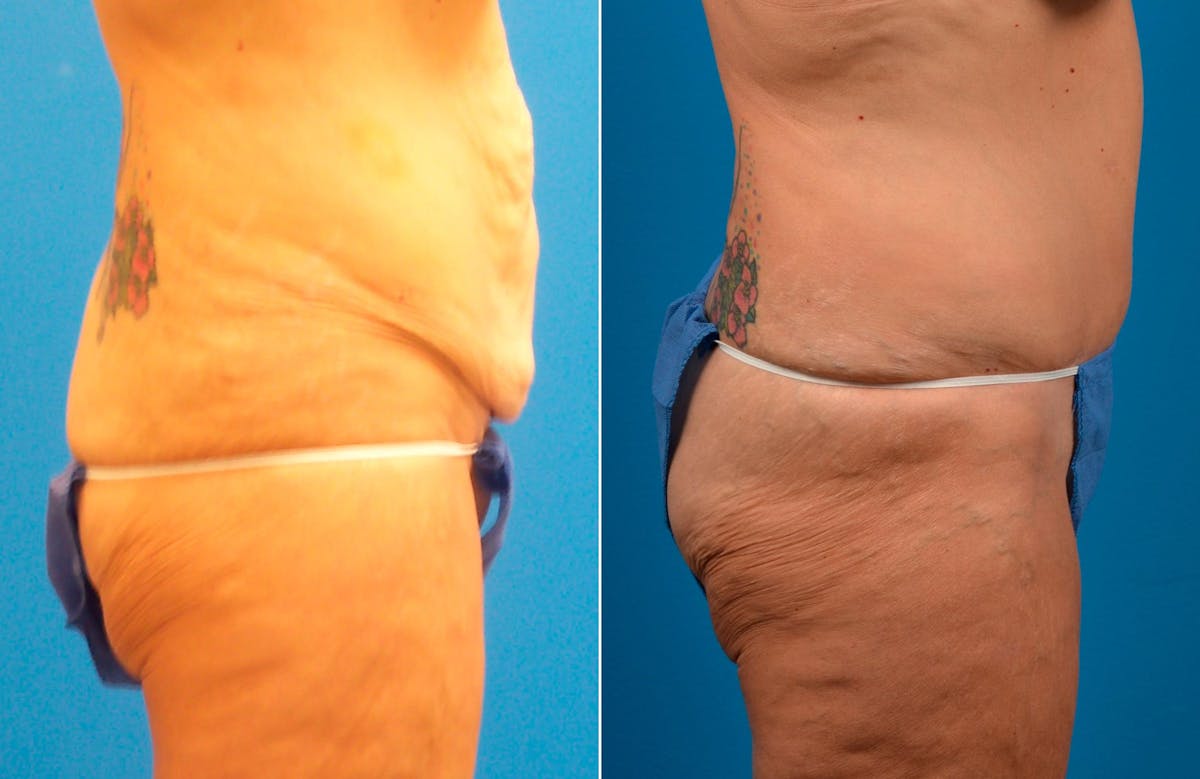 Tummy Tuck Before & After Gallery - Patient 125223 - Image 2