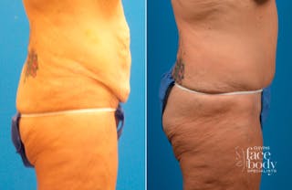 Hidden Tummy Tuck Before & After Gallery - Patient 349113 - Image 2