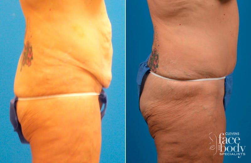 Hidden Tummy Tuck Before & After Gallery - Patient 349113 - Image 2