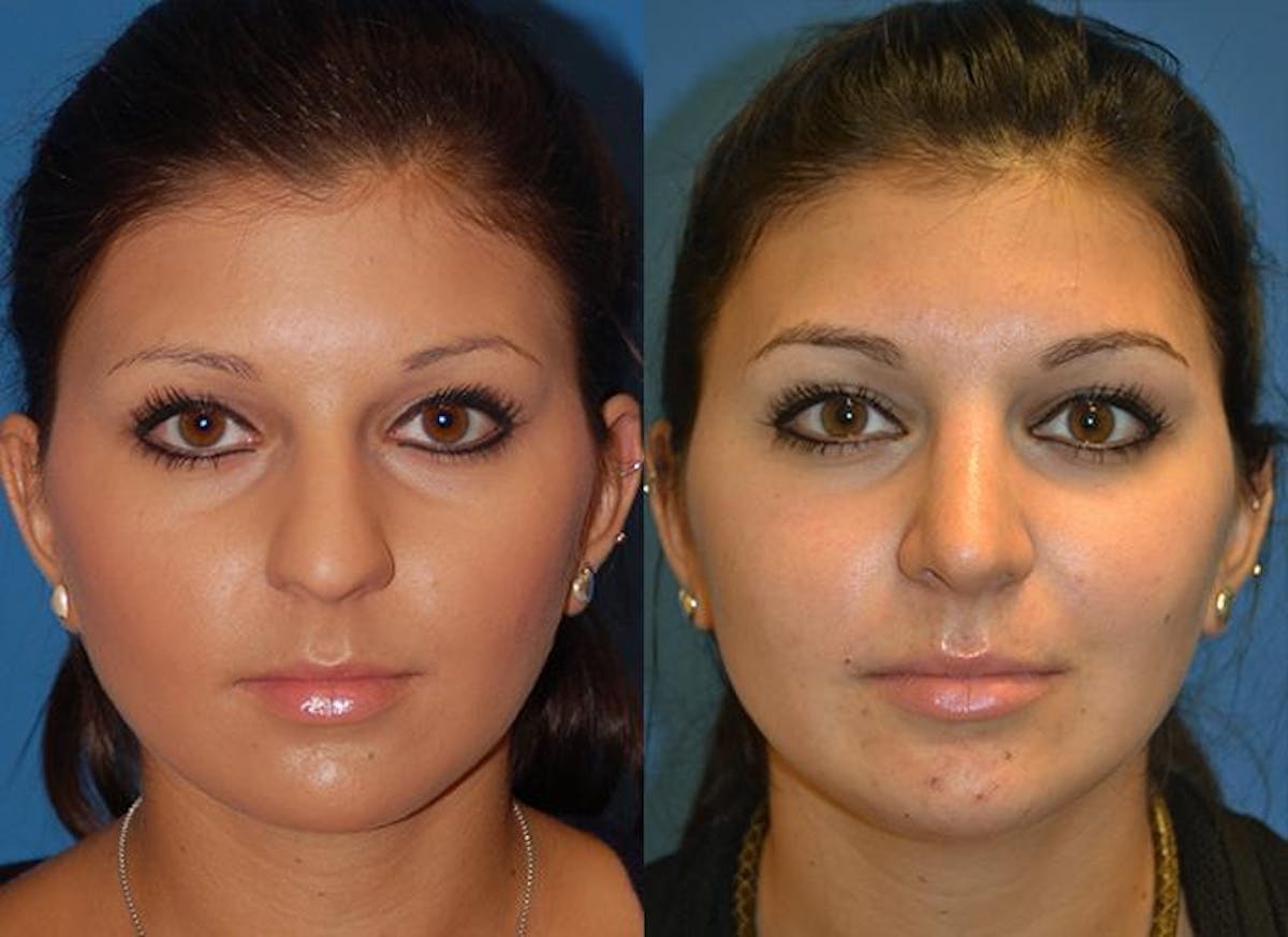 Rhinoplasty Before & After Gallery - Patient 122406751 - Image 1