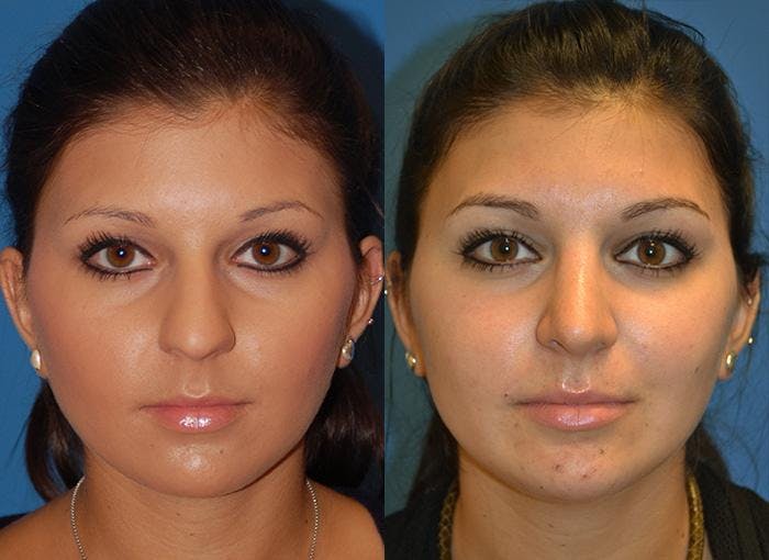 Rhinoplasty Before & After Gallery - Patient 122406751 - Image 1