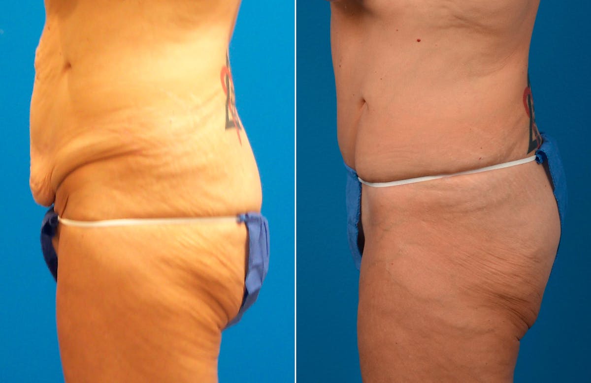 Tummy Tuck Before & After Gallery - Patient 125223 - Image 3