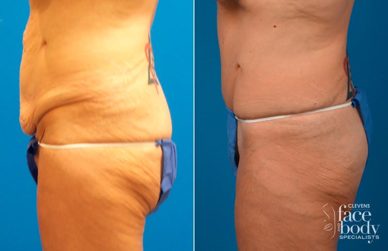 Hidden Tummy Tuck Before & After Gallery - Patient 349113 - Image 3
