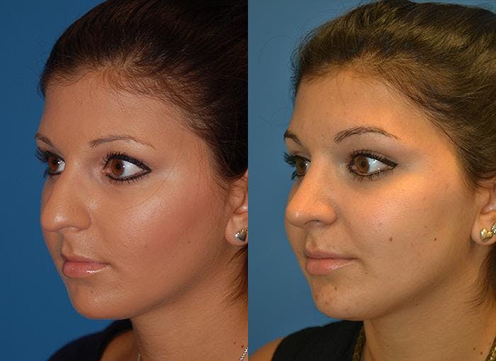 Rhinoplasty Before & After Gallery - Patient 122406751 - Image 2