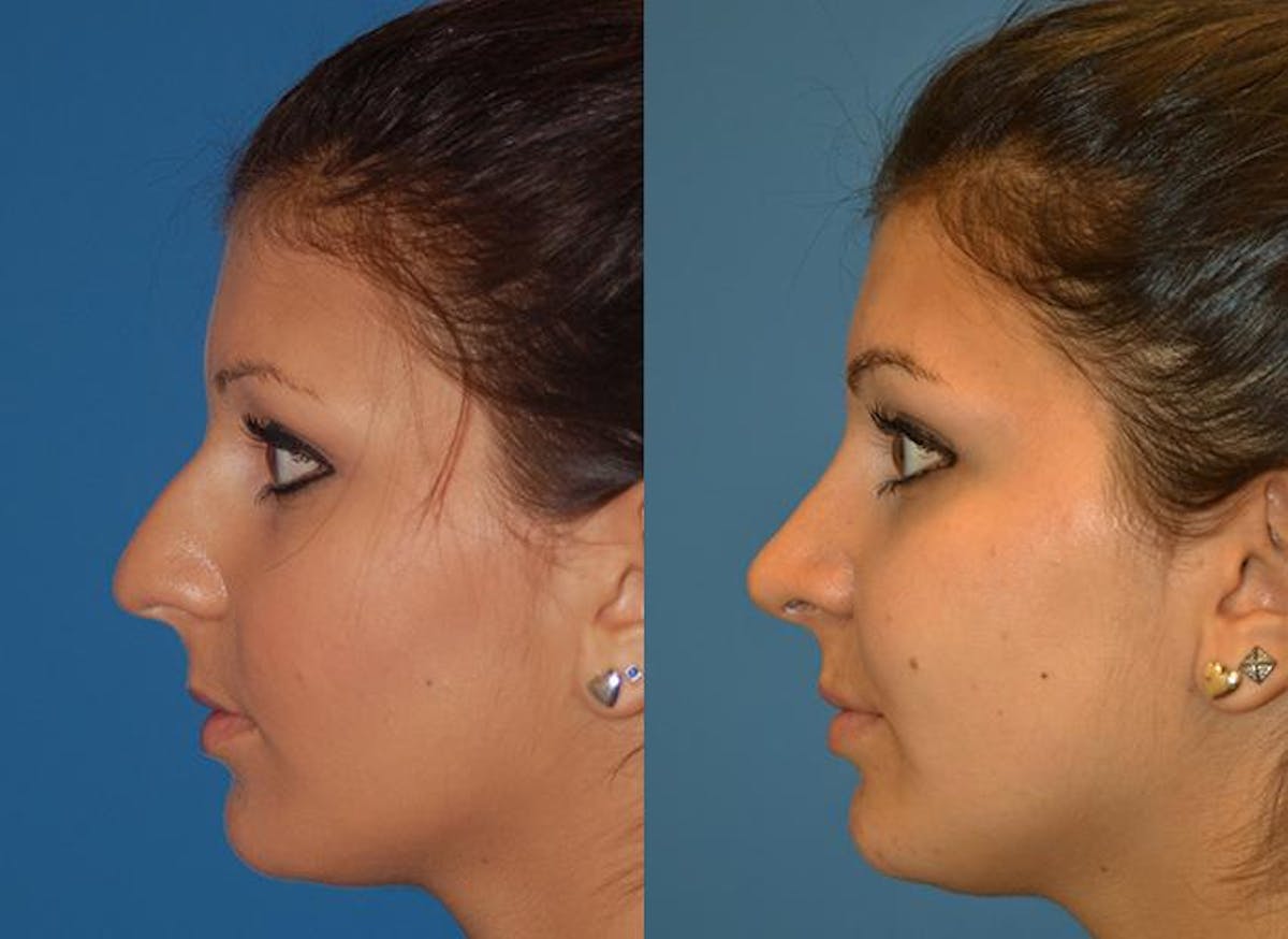 Rhinoplasty Before & After Gallery - Patient 122406751 - Image 3