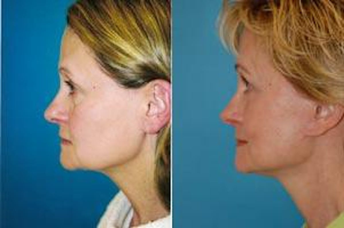 Skin Resurfacing Before & After Gallery - Patient 122406752 - Image 3