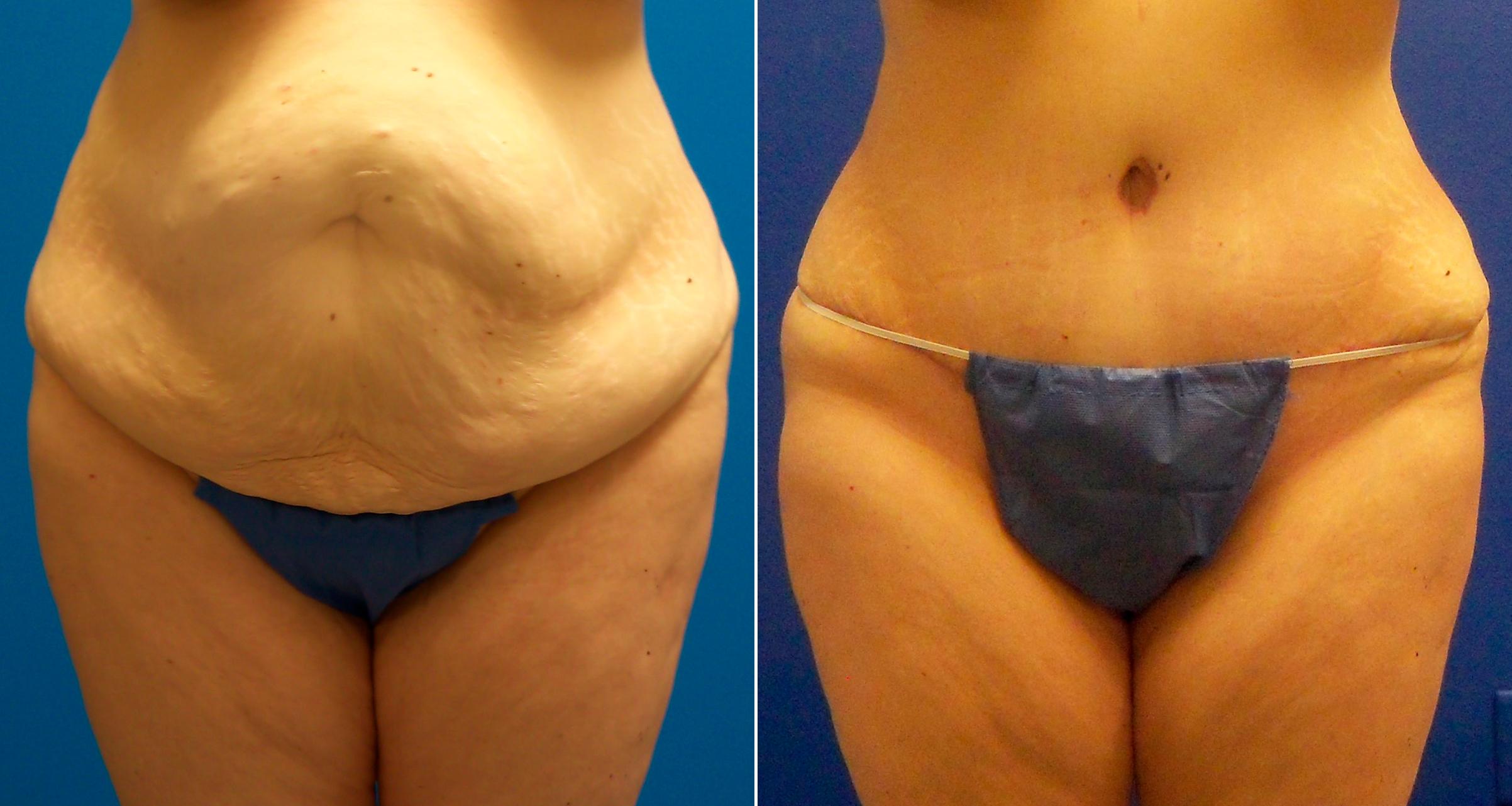 Hidden Tummy Tuck Before & After Gallery - Patient 350496 - Image 1