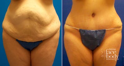 Hidden Tummy Tuck Before & After Gallery - Patient 350496 - Image 1