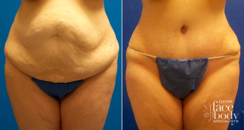 Hidden Tummy Tuck Before & After Gallery - Patient 350496 - Image 1
