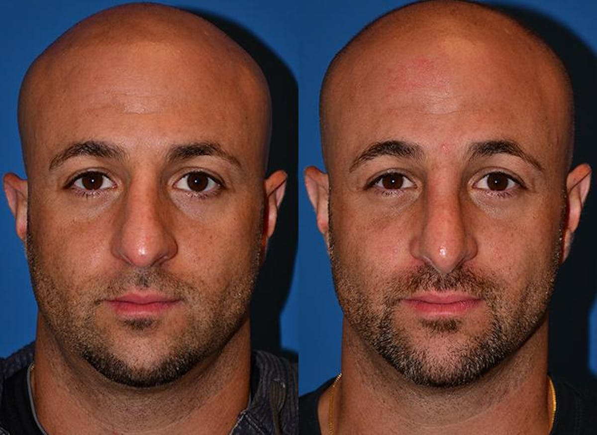 Rhinoplasty Before & After Gallery - Patient 122406757 - Image 1