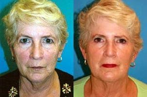 Skin Resurfacing Before & After Gallery - Patient 122406753 - Image 1