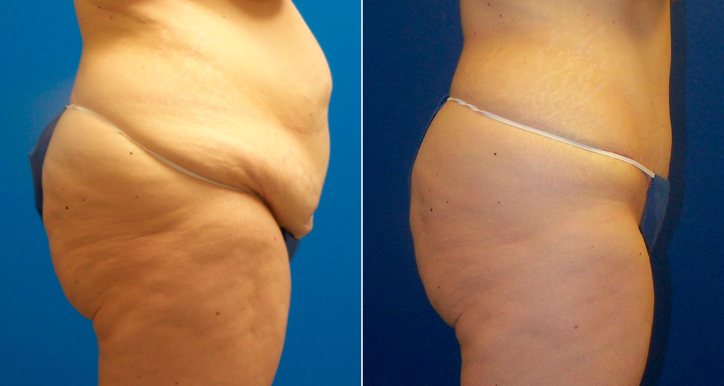 Hidden Tummy Tuck Before & After Gallery - Patient 350496 - Image 2