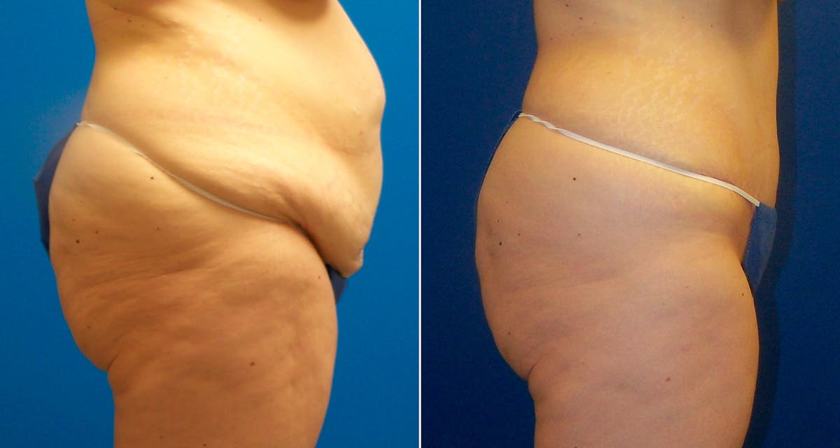 Tummy Tuck Before & After Gallery - Patient 749734 - Image 2