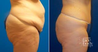 Hidden Tummy Tuck Before & After Gallery - Patient 350496 - Image 2