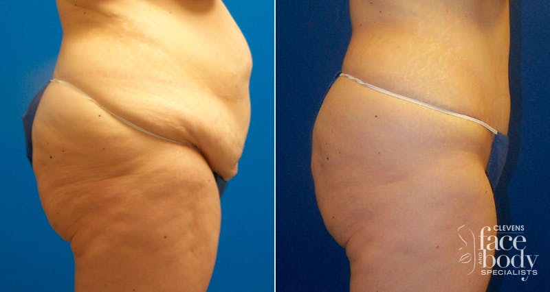 Hidden Tummy Tuck Before & After Gallery - Patient 350496 - Image 2