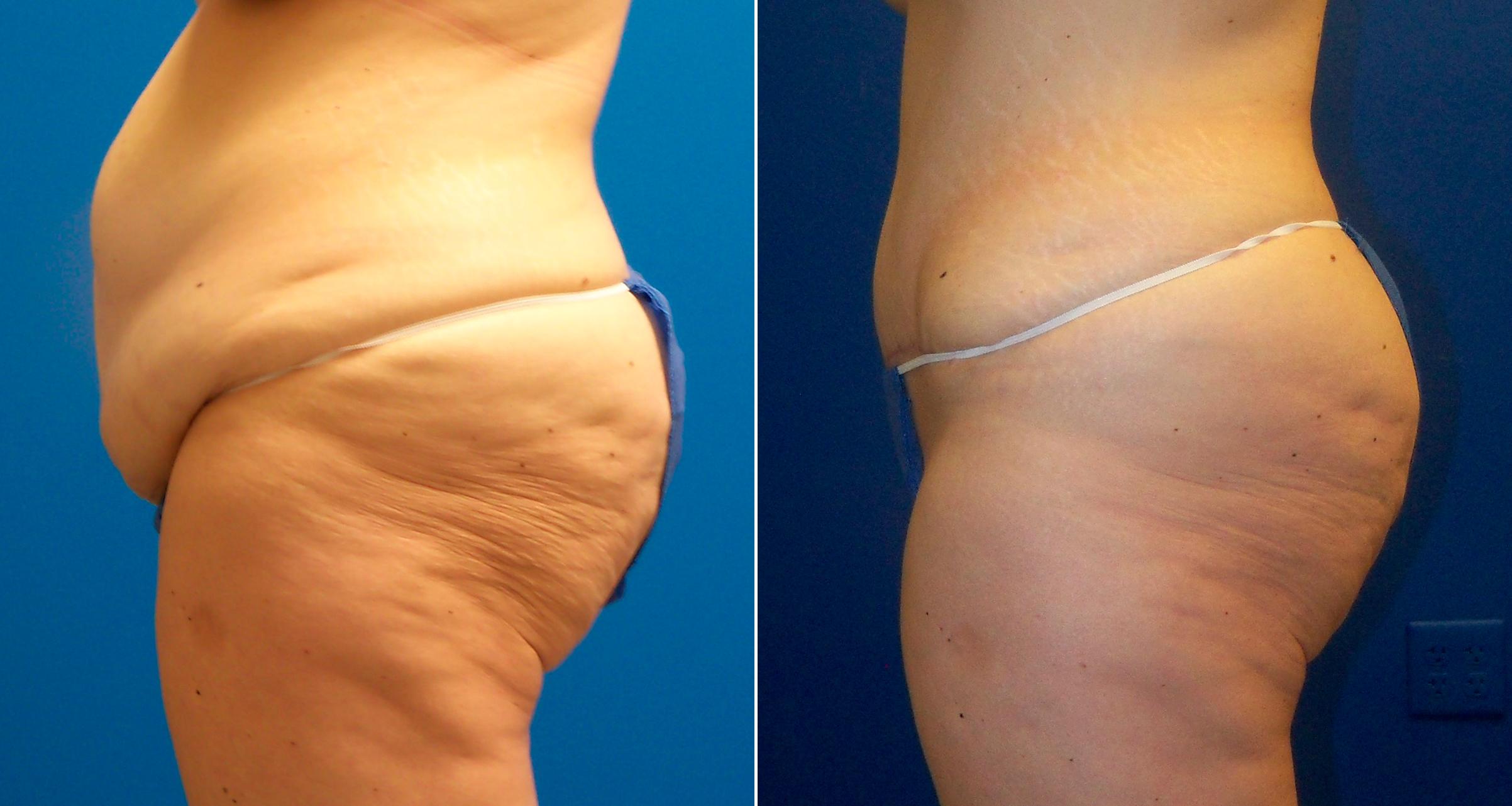 Hidden Tummy Tuck Before & After Gallery - Patient 350496 - Image 3