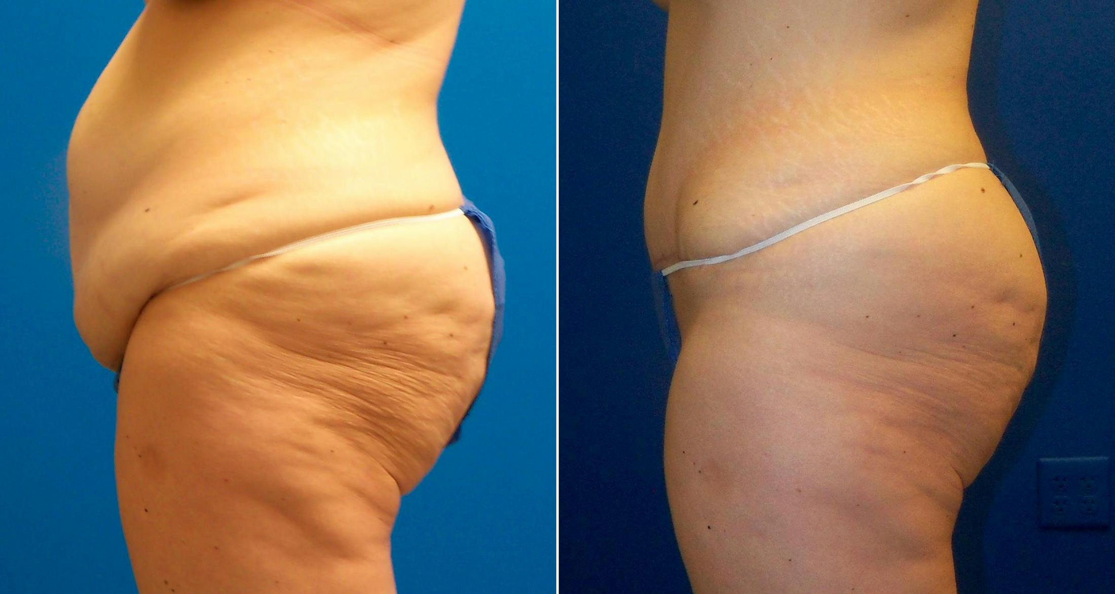 Tummy Tuck Gallery - Patient 122406755 - Image 3