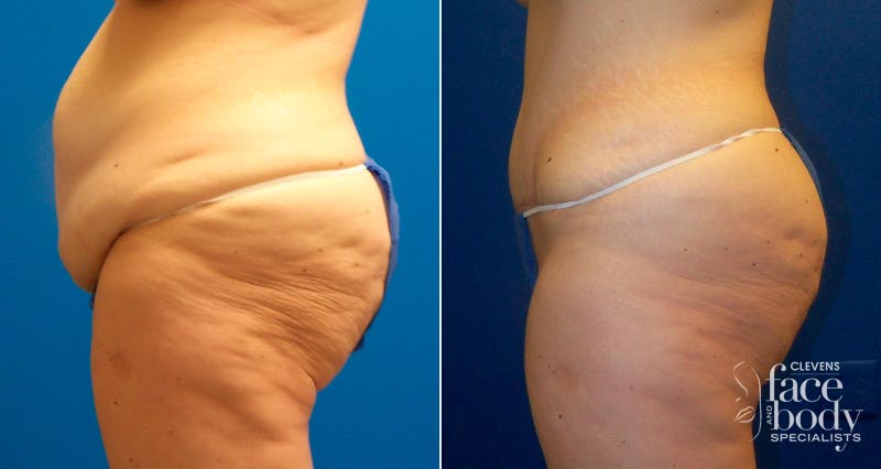 Hidden Tummy Tuck Before & After Gallery - Patient 350496 - Image 3