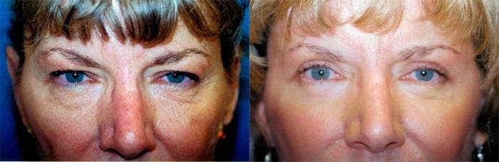 Skin Resurfacing Before & After Gallery - Patient 122406754 - Image 1