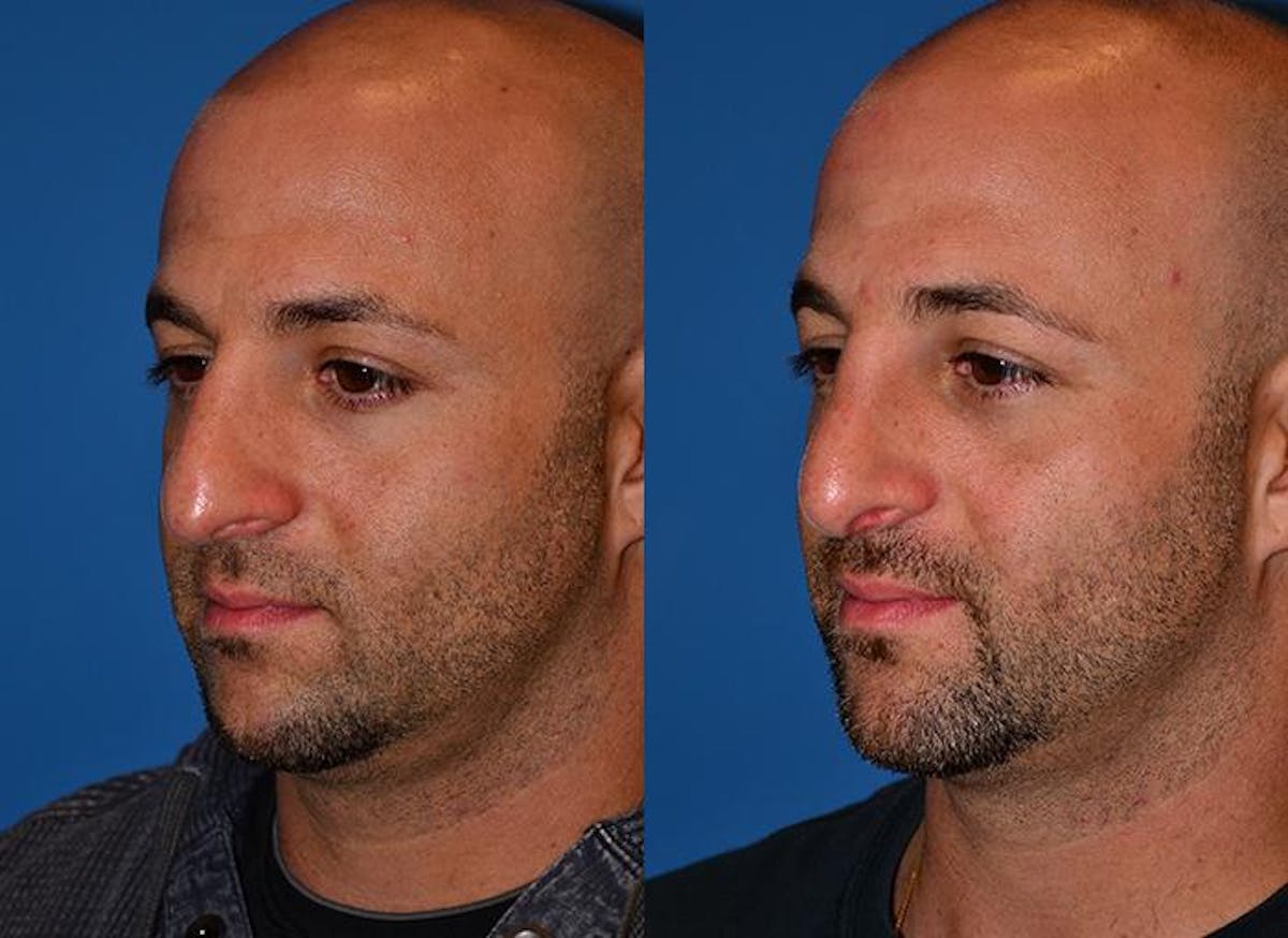 Rhinoplasty Before & After Gallery - Patient 122406757 - Image 4