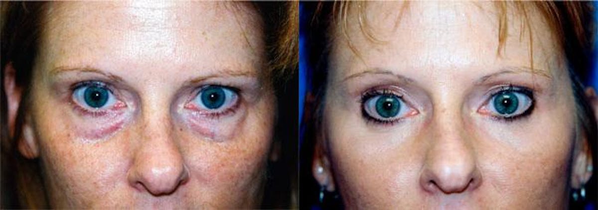 Skin Resurfacing Before & After Gallery - Patient 122406756 - Image 1
