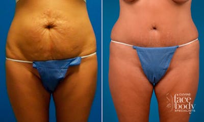 Hidden Tummy Tuck Before & After Gallery - Patient 257377 - Image 1