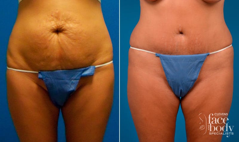 Hidden Tummy Tuck Before & After Gallery - Patient 257377 - Image 1