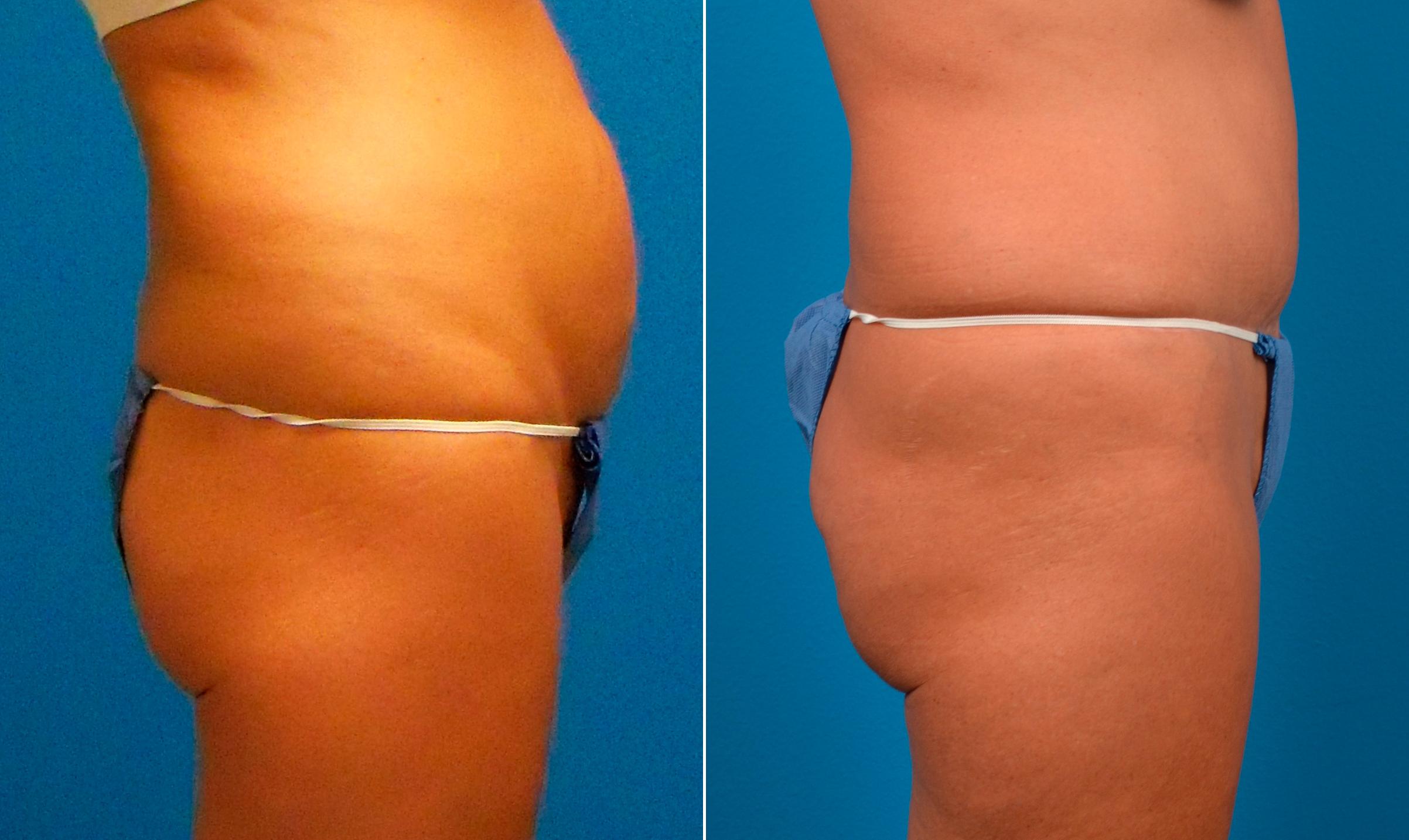 Hidden Tummy Tuck Before & After Gallery - Patient 257377 - Image 2