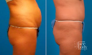 Hidden Tummy Tuck Before & After Gallery - Patient 257377 - Image 2