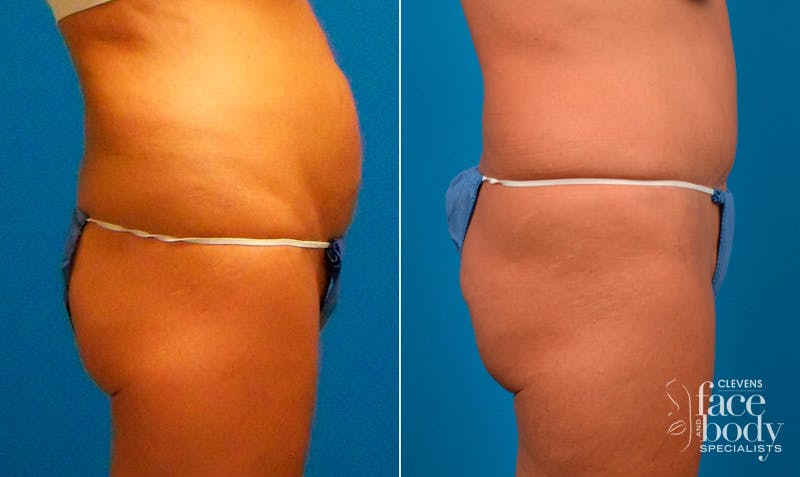 Hidden Tummy Tuck Before & After Gallery - Patient 257377 - Image 2