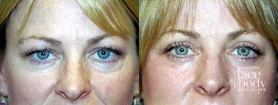 Eyelid Surgery Before & After Gallery - Patient 291440 - Image 1
