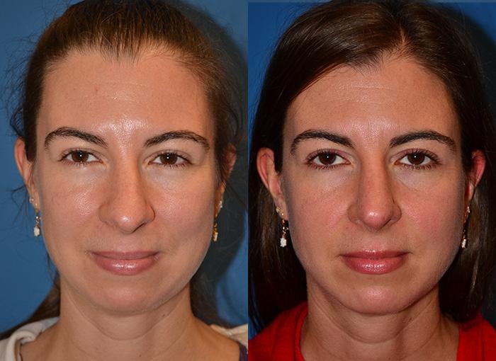 Rhinoplasty Before & After Gallery - Patient 122406761 - Image 1