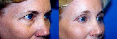 Skin Resurfacing Before & After Gallery - Patient 122406759 - Image 1
