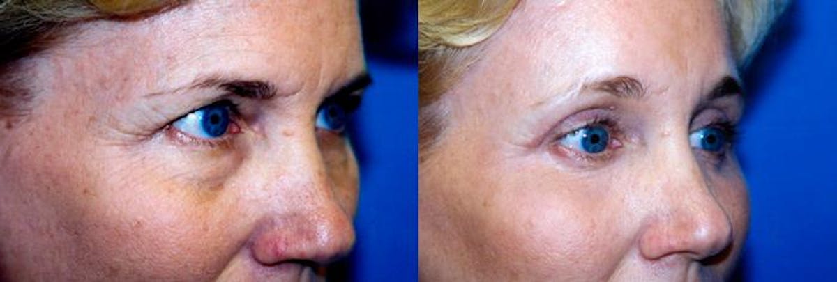 Skin Resurfacing Before & After Gallery - Patient 122406759 - Image 1