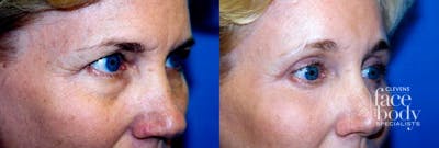 Eyelid Surgery Before & After Gallery - Patient 204782 - Image 1