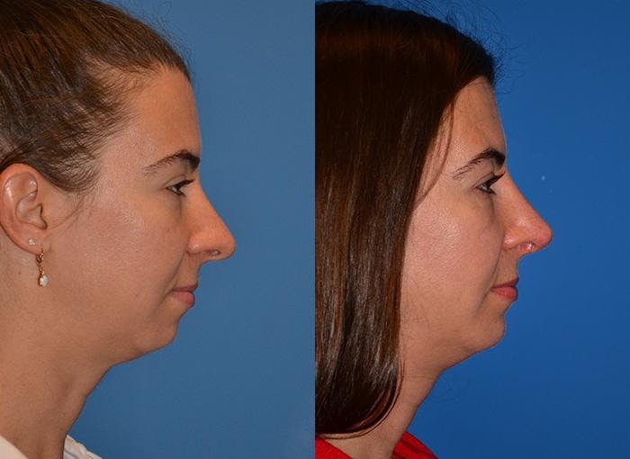 Rhinoplasty Before & After Gallery - Patient 122406761 - Image 2