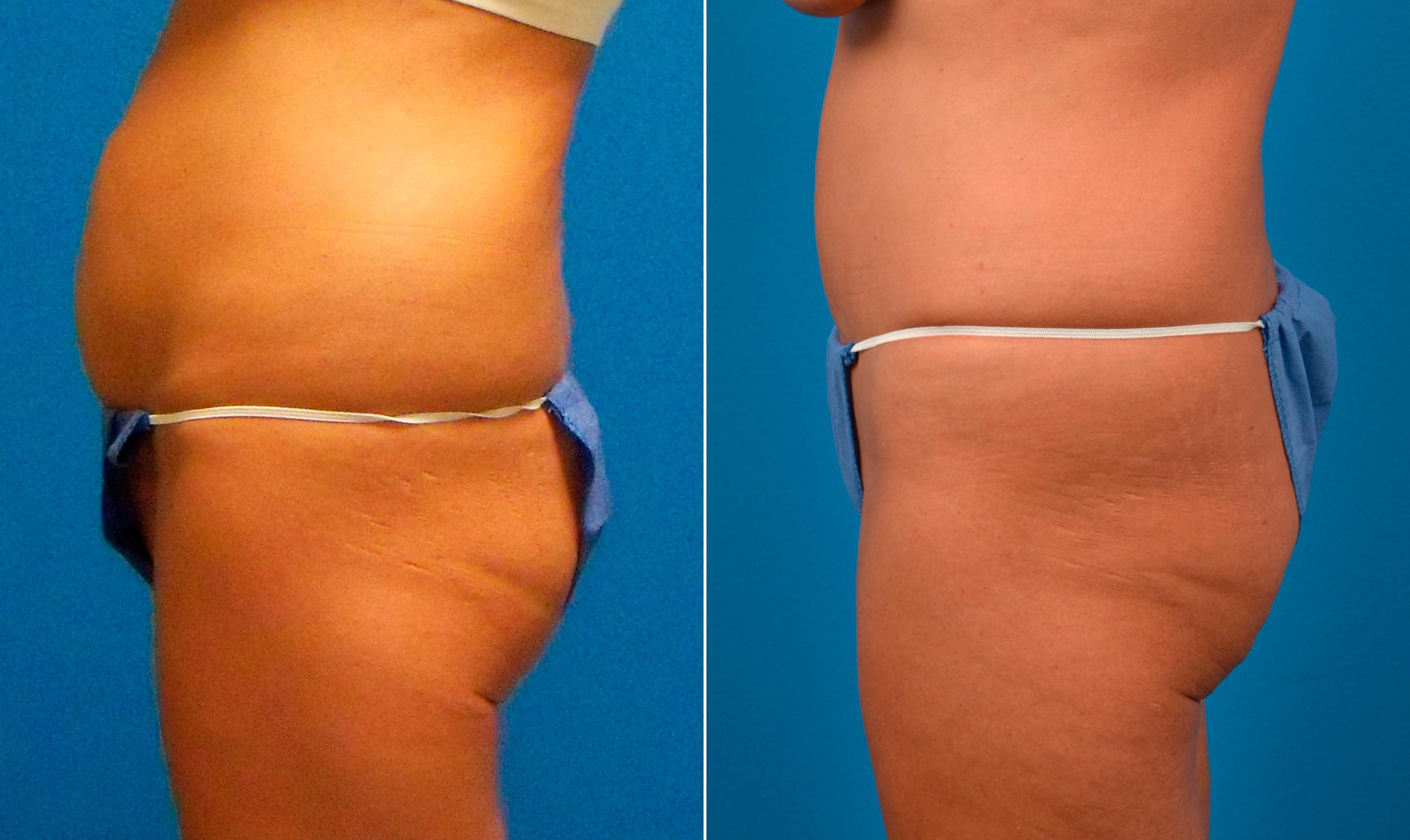 Hidden Tummy Tuck Before & After Gallery - Patient 257377 - Image 3