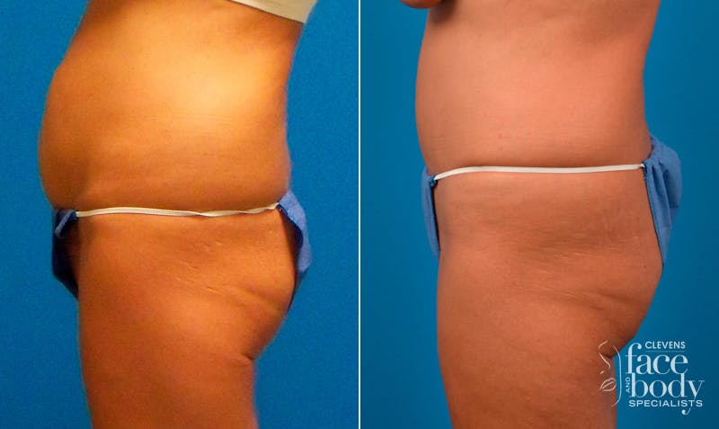 Hidden Tummy Tuck Before & After Gallery - Patient 257377 - Image 3