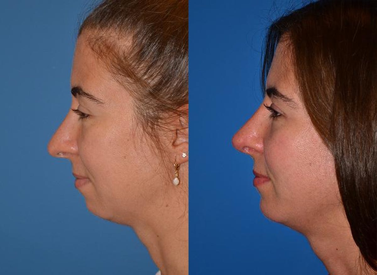 Rhinoplasty Before & After Gallery - Patient 122406761 - Image 3