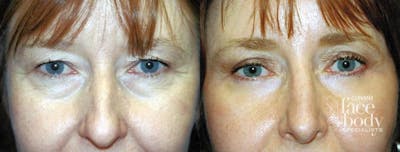 Eyelid Surgery Before & After Gallery - Patient 139141 - Image 1