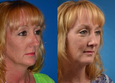 Rhinoplasty Before & After Gallery - Patient 122406763 - Image 1