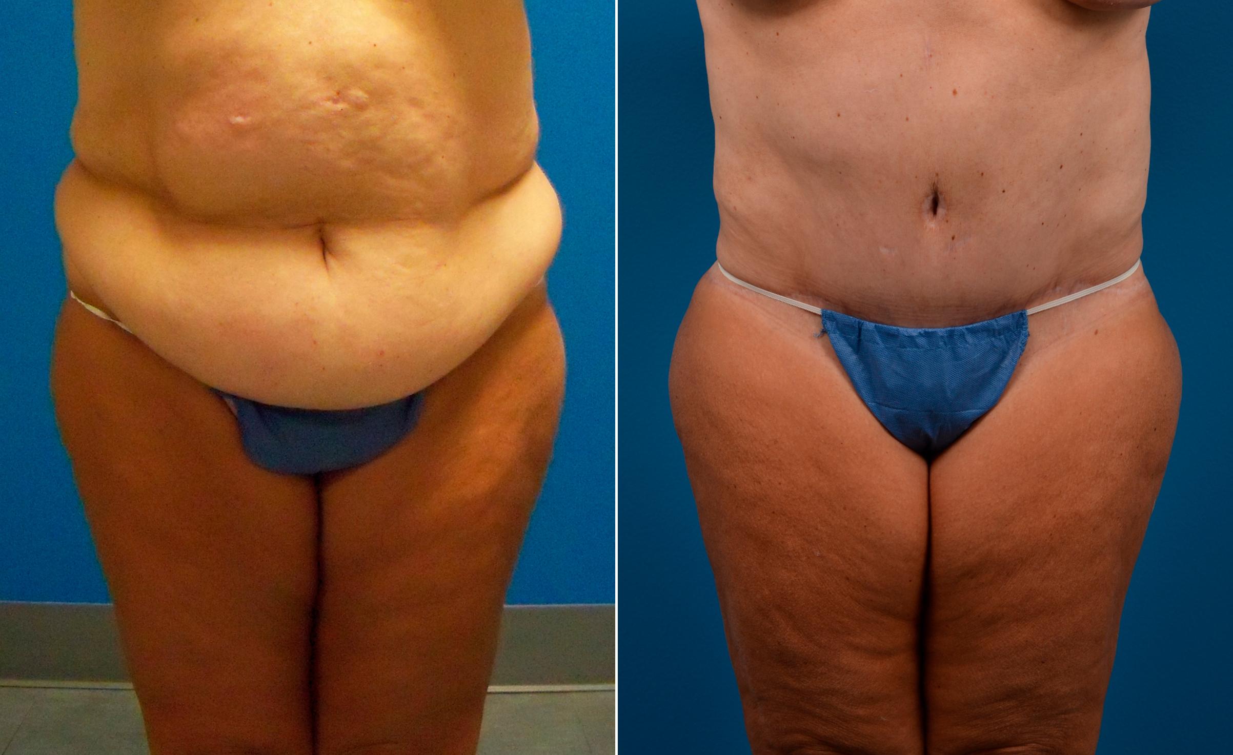 Hidden Tummy Tuck Before & After Gallery - Patient 173773 - Image 1