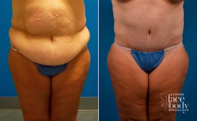 Hidden Tummy Tuck Before & After Gallery - Patient 173773 - Image 1