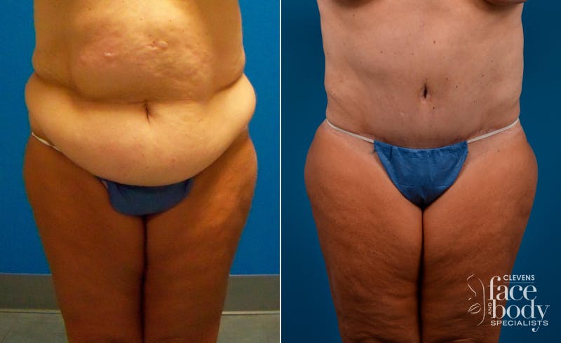 Hidden Tummy Tuck Before & After Gallery - Patient 173773 - Image 1