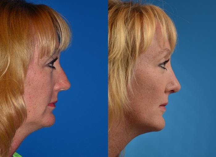 Rhinoplasty Before & After Gallery - Patient 122406763 - Image 2