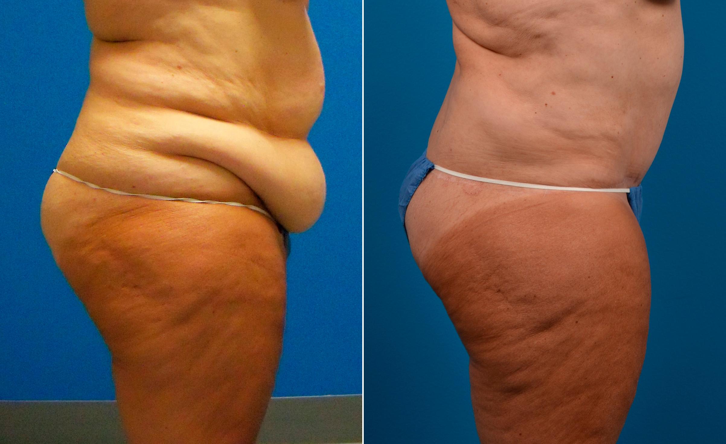 Hidden Tummy Tuck Before & After Gallery - Patient 173773 - Image 2